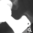 Osteolyse um einen Prothesenschaft (Pfeile)